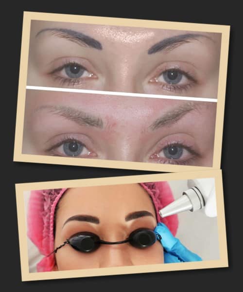 видалити татуаж брів