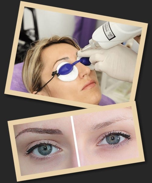 протипоказання лазерного видалення татуажу брів