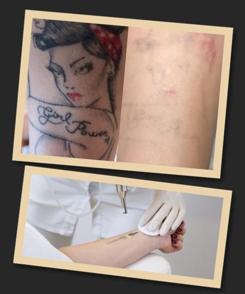 Лазерне видалення тату популярне у Києві