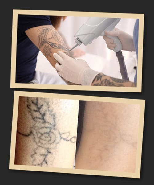 Методи видалення татуювань