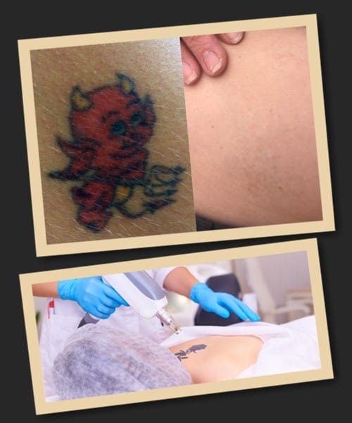 видалення тату лазером