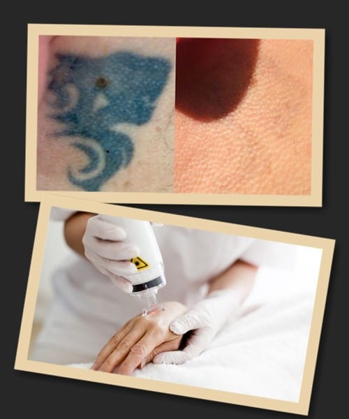 лазерний метод видалення тату