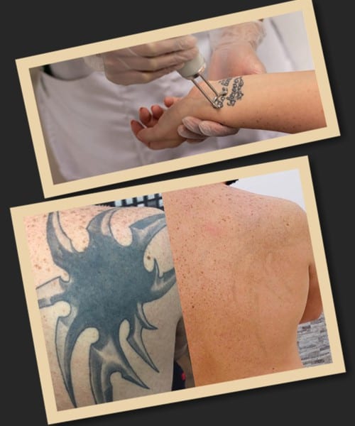 лазерне видалення тату