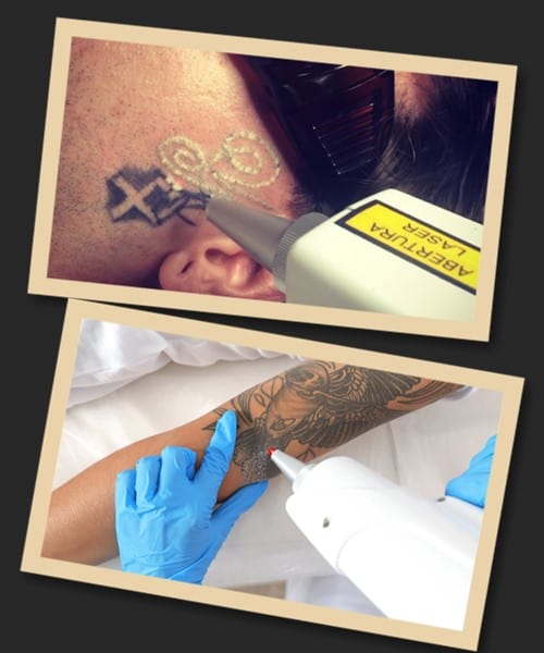 Переваги лазерного методу видалення тату