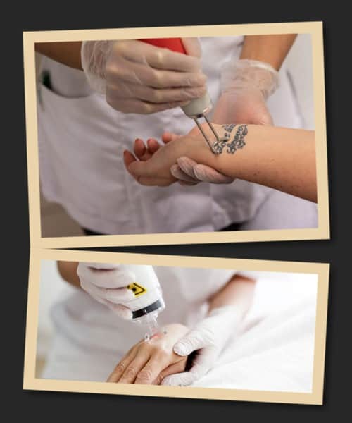 Лазерне видалення тату