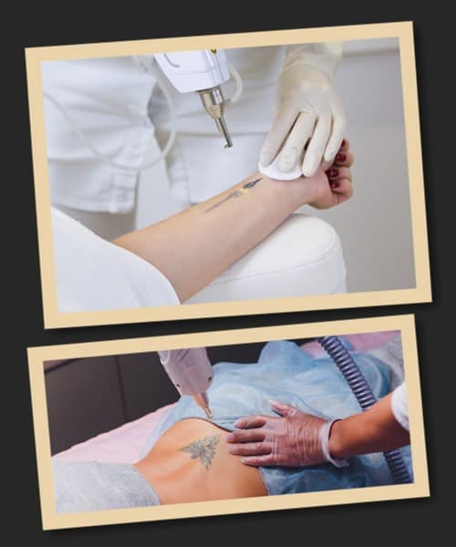 Які фактори впливають на ціну виведення тату