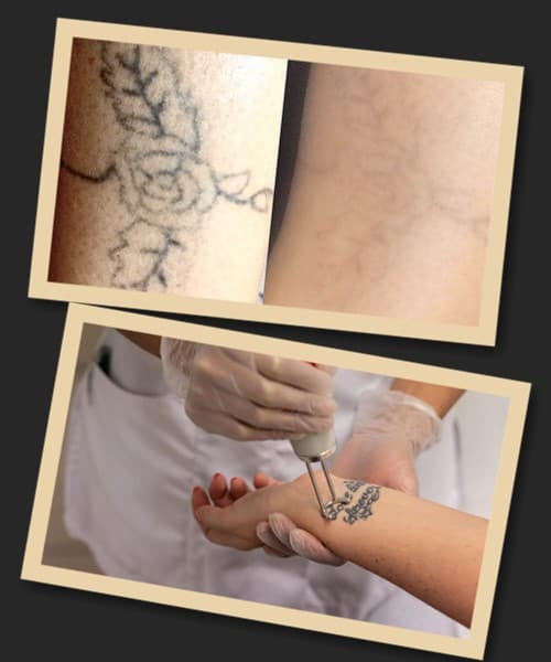 Шкіра на місці татуювання після видалення