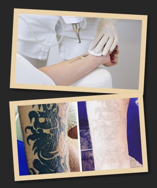 Якими методами видаляють татуювання