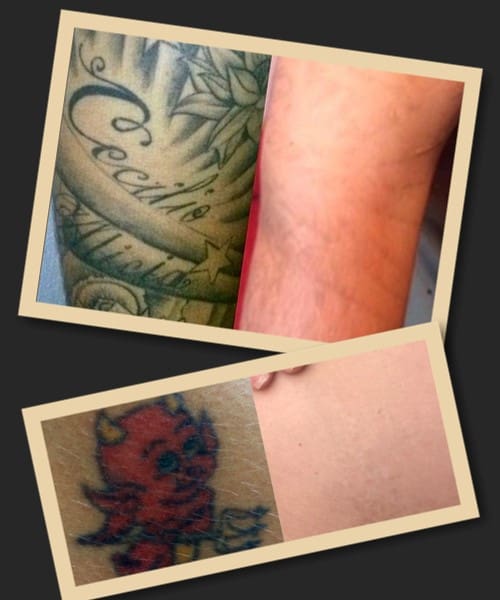 Правила догляду за шкірою після видалення татуювання