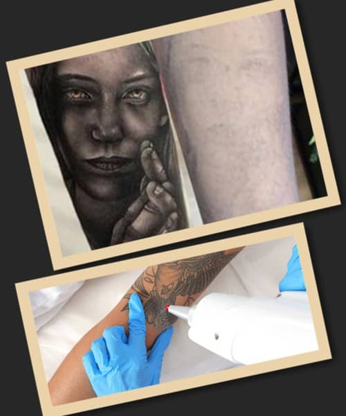 Чим цінний лазерний метод видалення тату