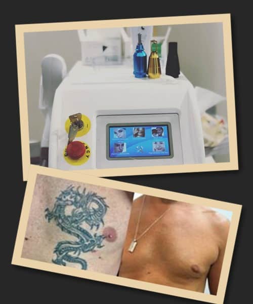 Лазерний метод видалення тату