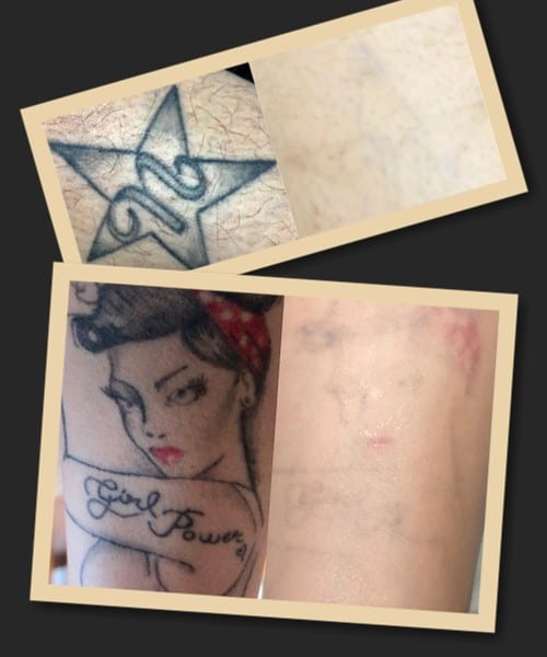 сеанс лазерного видалення тату