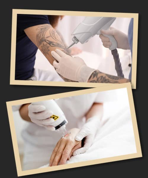 Видалення свіжого тату лазером