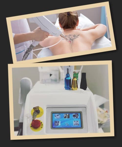 Видалення свіжого татуювання лазером