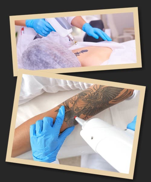 лазерне видалення тату