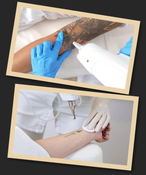 Видалення татуювання без болю