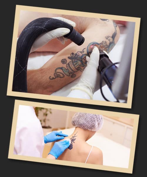 лазерне видалення тату