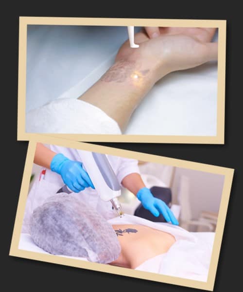 видалення тату без болю за допомогою лазера