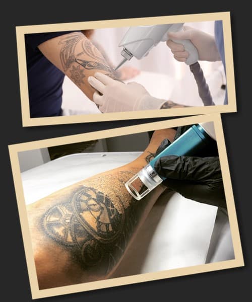 Видалення тату без болю