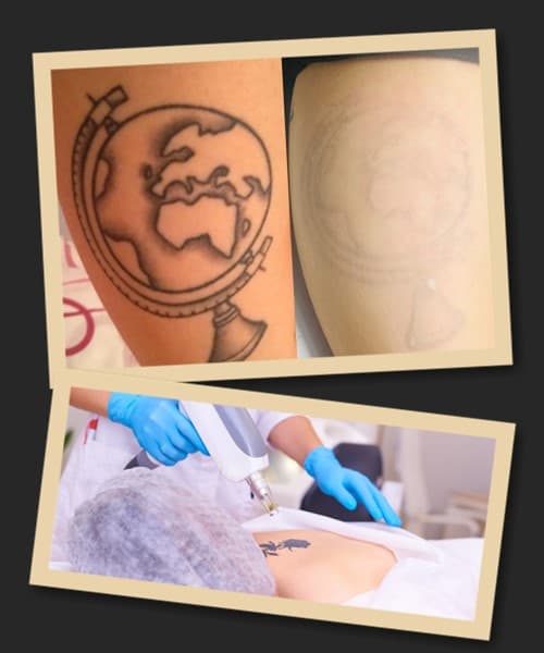 Видалення татуювань лазером: наслідки