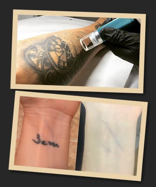 видалення тату лазером