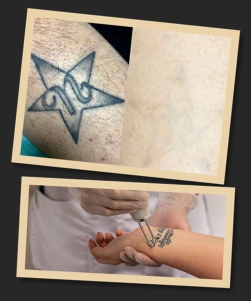 видалення тату лазером наслідки