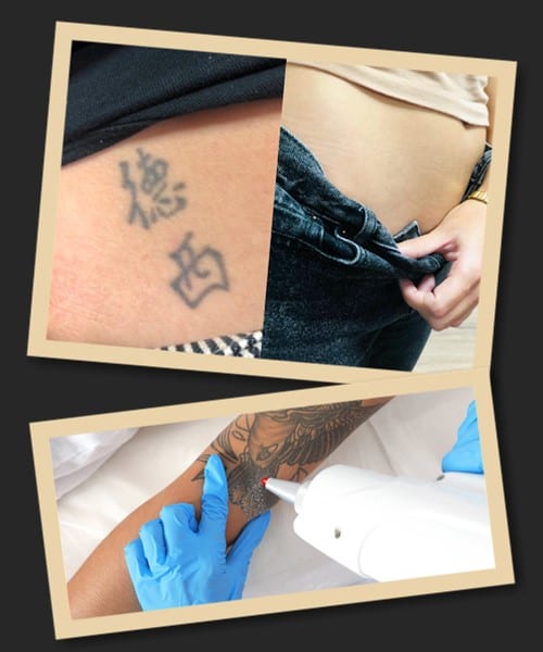 Лазерний метод видалення тату у салонах Києва