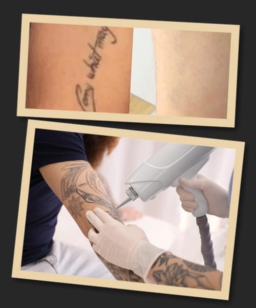 Переваги лазерного методу видалення тату