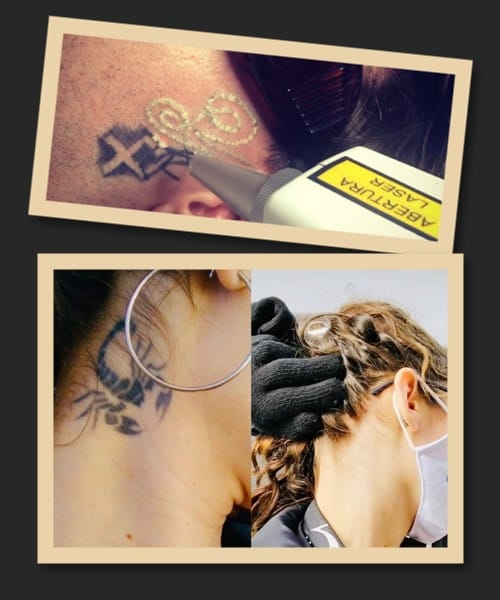 зведення татуювання лазером