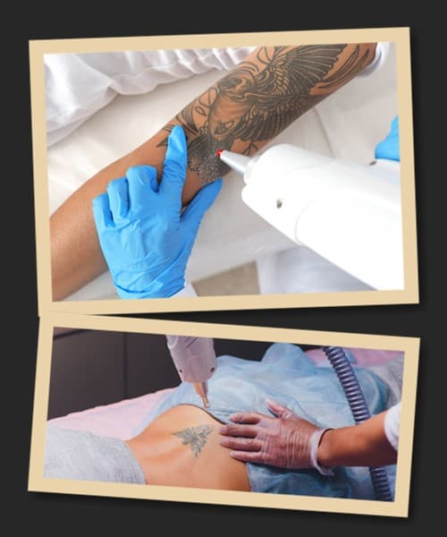 Видалення татуювань пікосекундним лазером у Києві