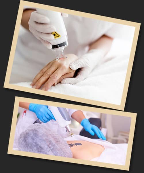 виведення татуювання лазером