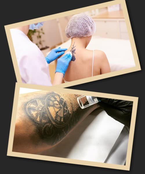 видалення тату пікосекундним лазером