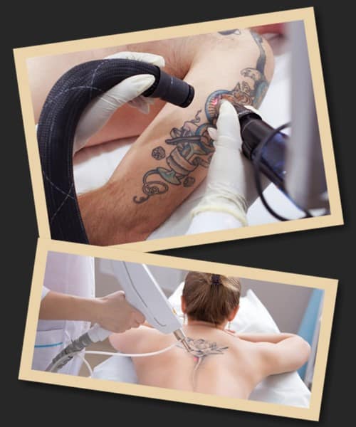 пікосекундний чи неодимовий лазер