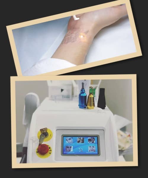 Види лазерів для виведення тату