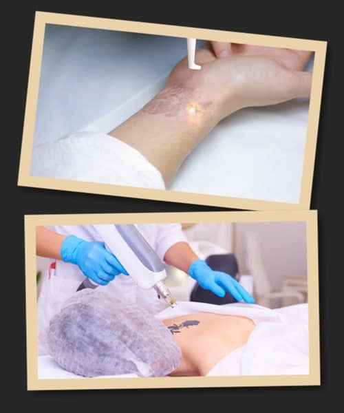 Видалення татуювання відразу після нанесення