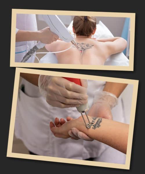 Приводи для видалення татуювання