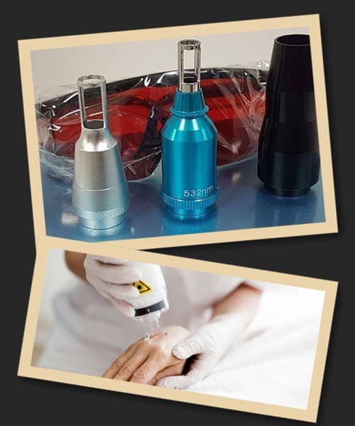 За допомогою лазера можна прибрати тату