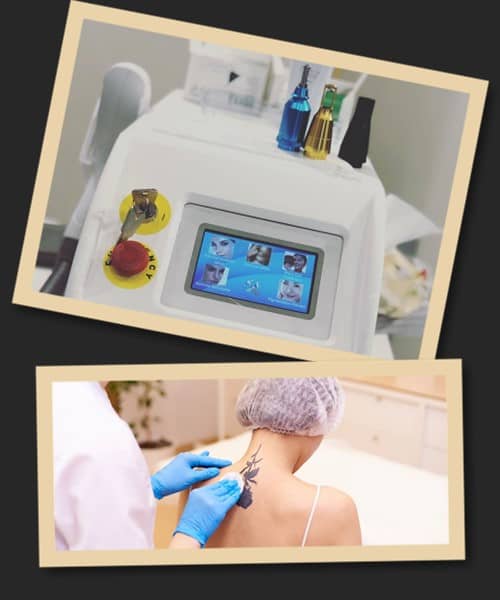 Застосування лазера для зведення татуювання