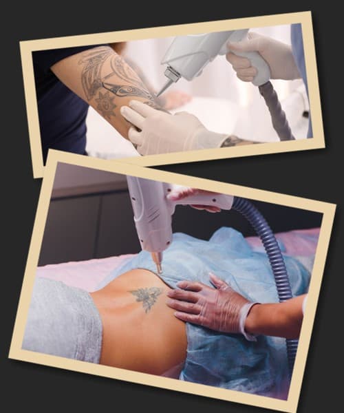 Наслідки виведення свіжого тату