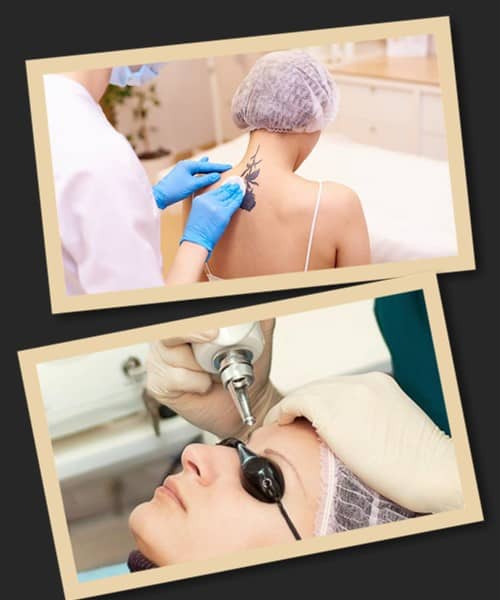 Видалення татуювань та татуажу Печерськ