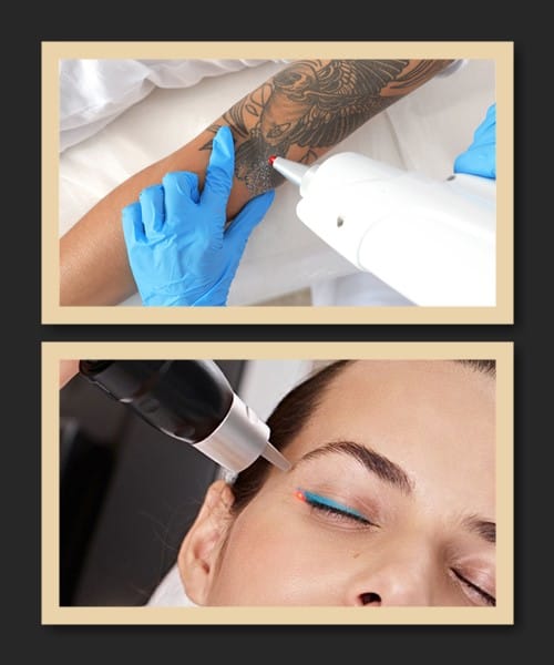 Методи зведення тату та перманента