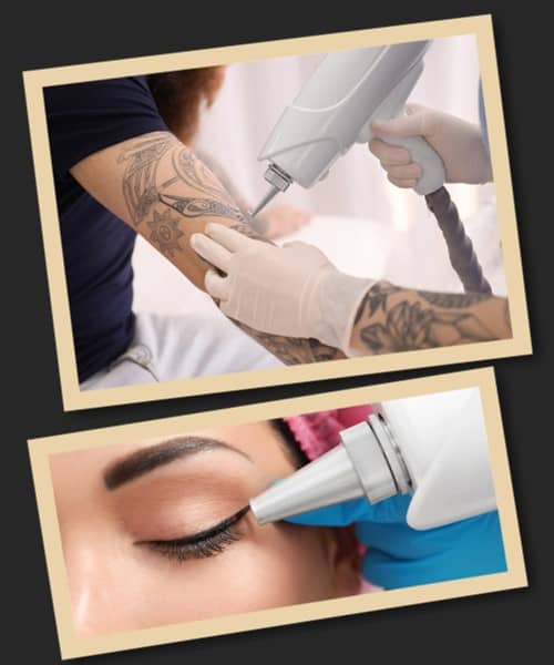 ефективний метод видалення татуювань та татуажу