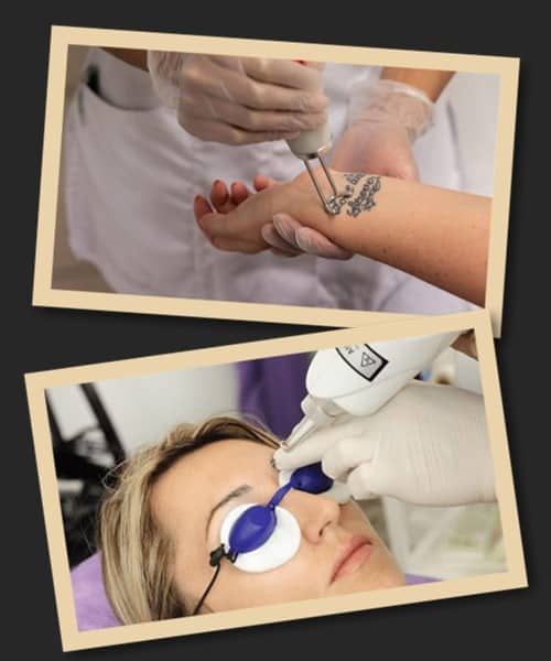 Чинники, що впливають швидкість виведення пігменту тату