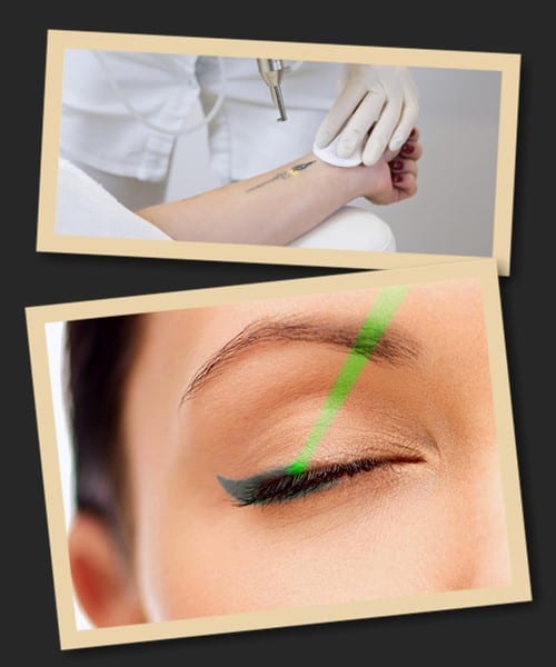 необхідно видалення татуювань та татуажу Печерськ