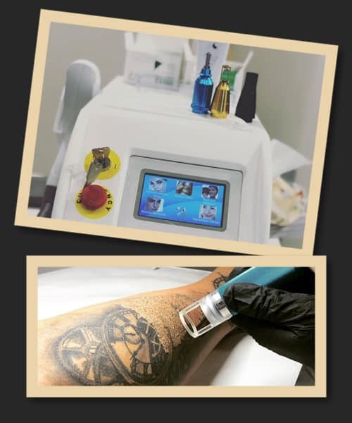 Лазерный метод выведения тату