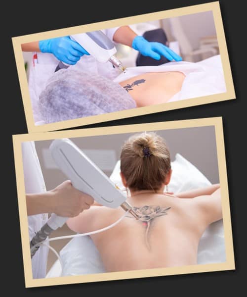 Навіщо видаляти татуювання