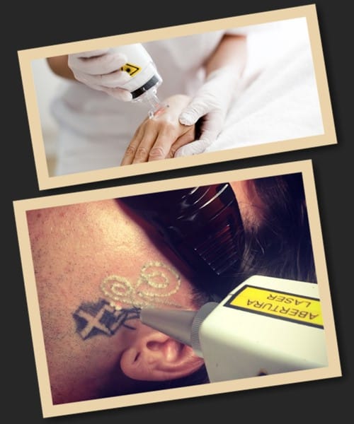 особливості лазерного методу