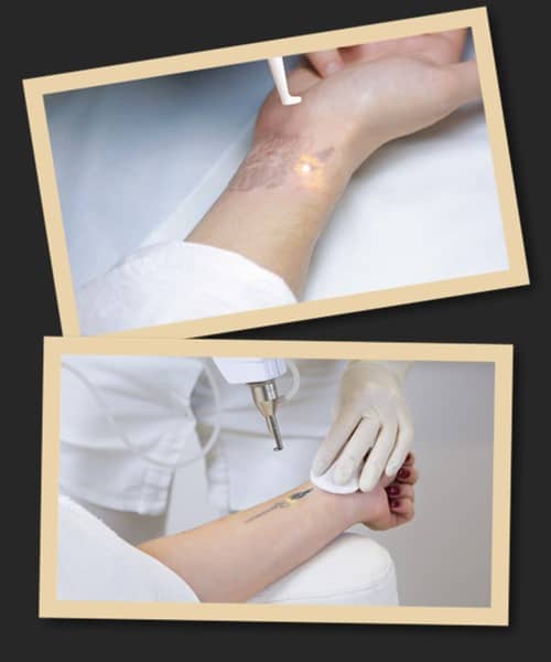 видалити тату без шрамів