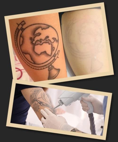 Ціни виведення татуювань у Києві