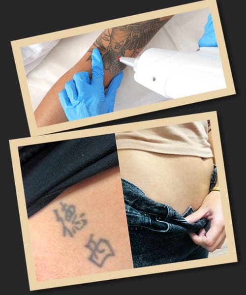 способи видалення тату